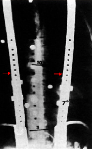 Scoliosis Scoliosis (16).gif